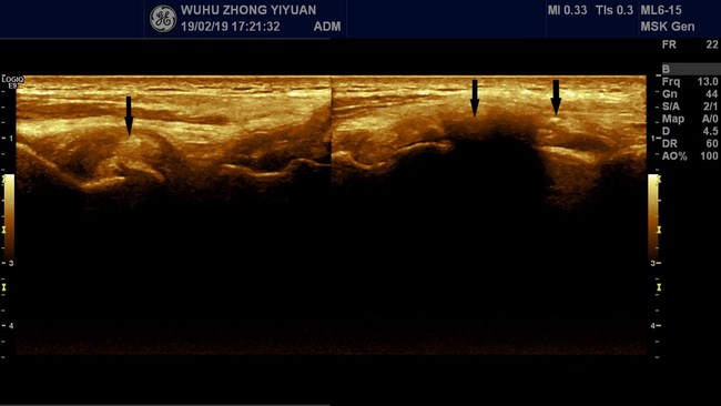 【新技術(shù)】我院功能1科開展肌骨超聲新技術(shù)(圖6)