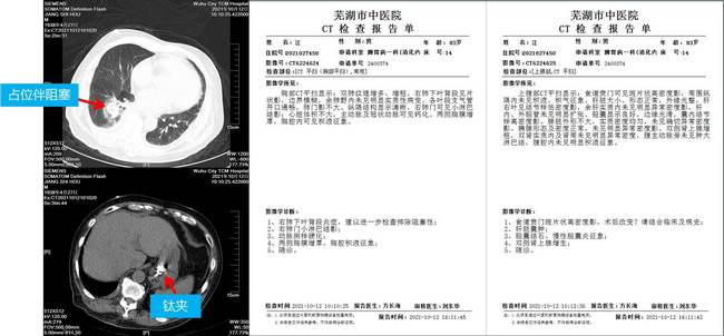 小鈦夾，威力大 ——記一例上消化道大出血患者的救治經(jīng)過(圖2)