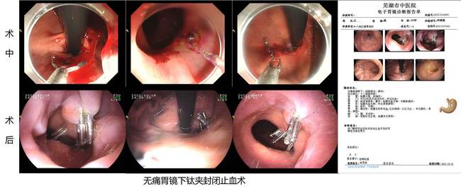 小鈦夾，威力大 ——記一例上消化道大出血患者的救治經(jīng)過(圖4)