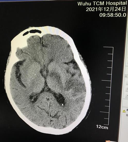 我院卒中中心救治團隊成功為一例高齡重癥腦卒中 患者行腦血管介入取栓手術(shù)(圖4)