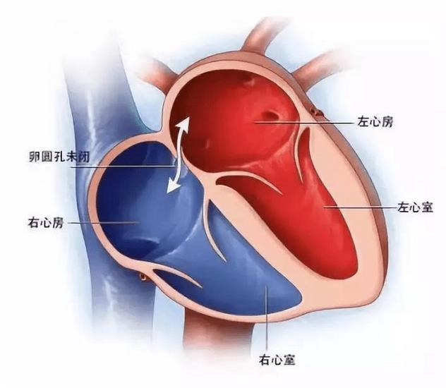 探尋不明原因卒中、偏頭痛根源的檢查技術—TCD發(fā)泡試驗(圖1)