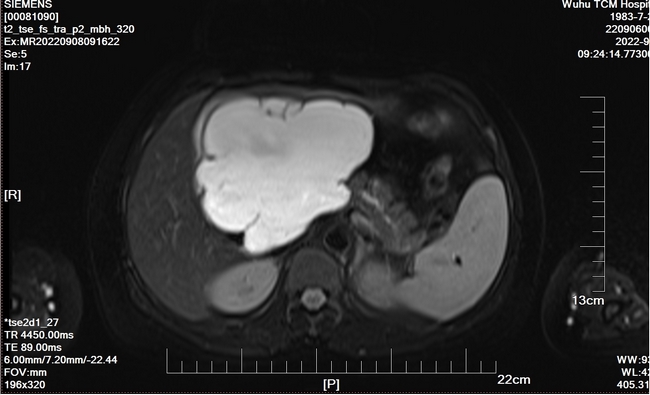 首例腹腔鏡胰十二指腸切除患者痊愈出院(圖2)